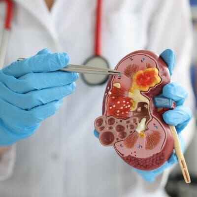 ayurvedic kidney treatment