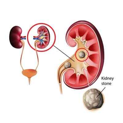 ayurvedic kidney treatment