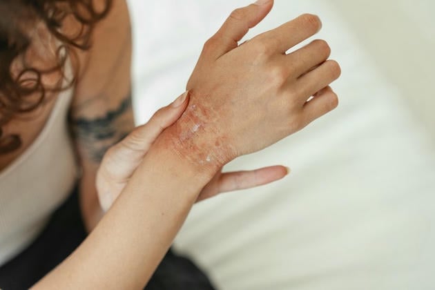 Natural Eczema Treatment